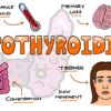 Hypothyroidism and Obesity