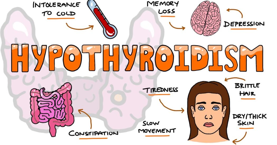 Hypothyroidism and Obesity