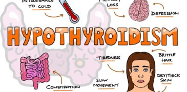 Hypothyroidism and Obesity